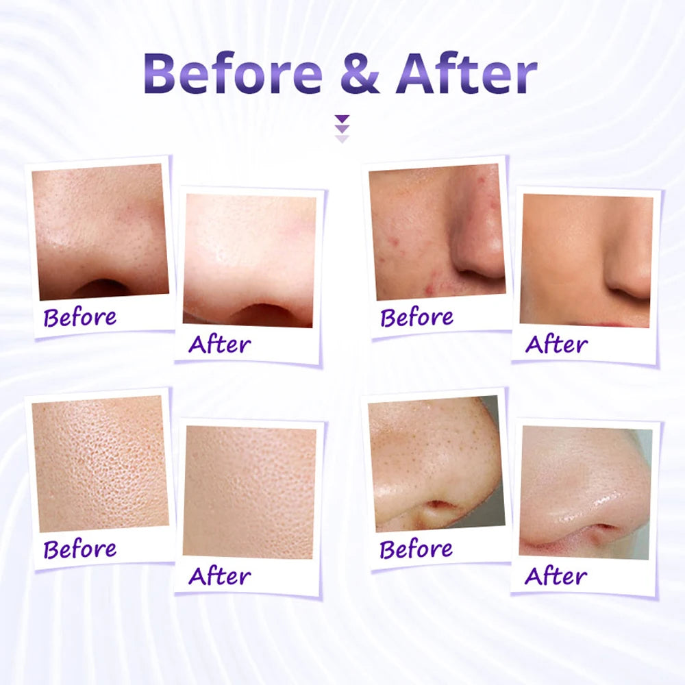 Diamond Tip Microdermabrasion Skin Rejuvenation Acne Remove