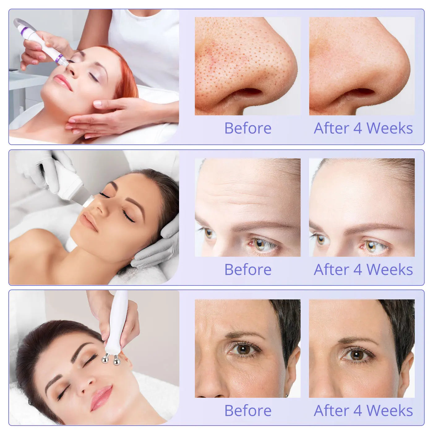 Hydro Blackhead Removal Skin Scrubber Facial Clean Machine