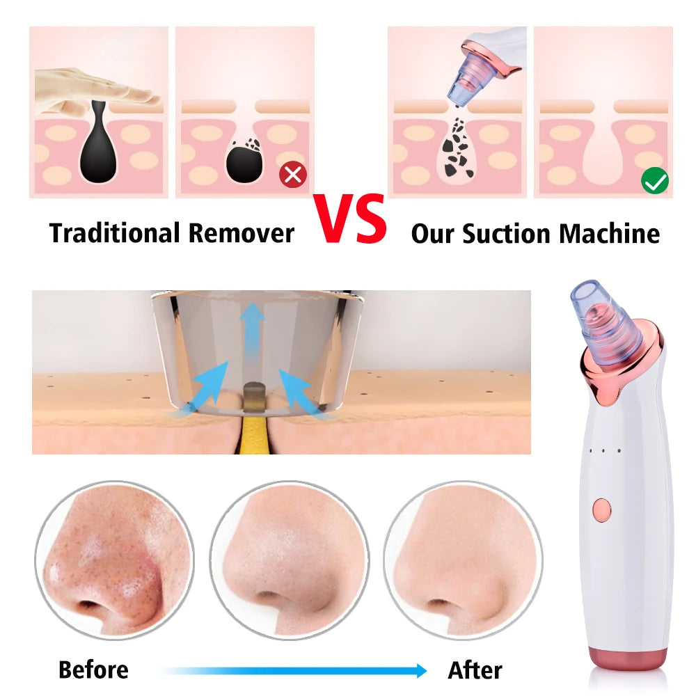 Vacuum Blackhead Removal Facial Cleansing Black Spots Suction 7