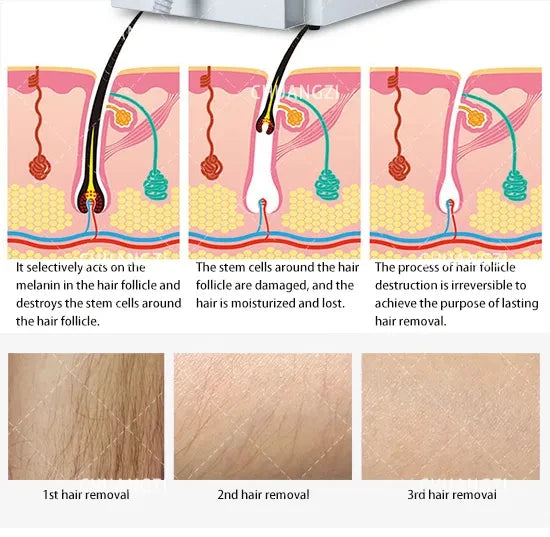 Laser Hair Removal Machine 3 wavelengths Painless