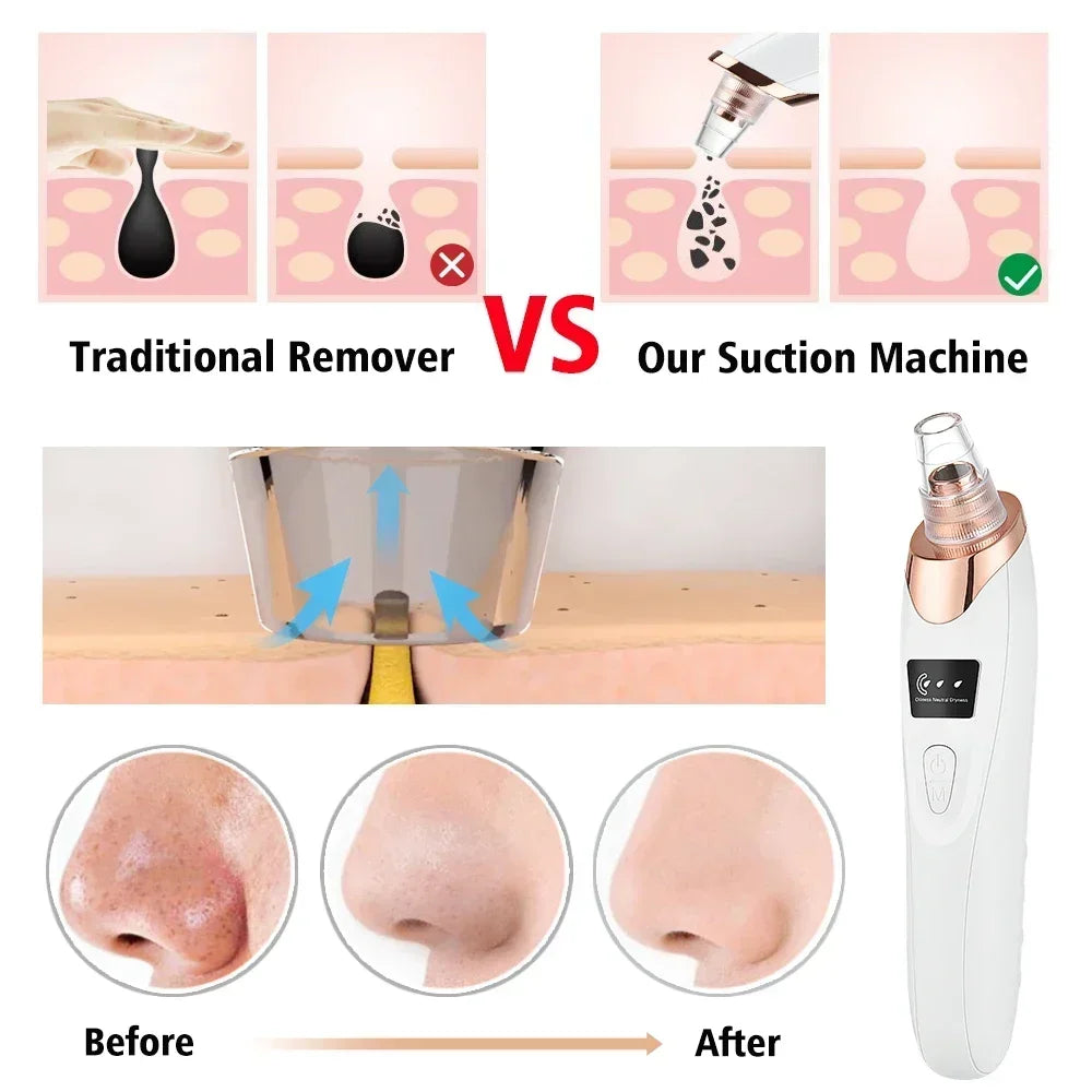 Electric Blackhead Remover Vacuum Suction Facial Pore Cleaner